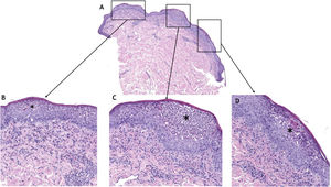 A) Panoramic view of the punch biopsy (hematoxylin–eosin, 2×). B–D) Presence of multiple subcorneal neutrophil accumulations with formation of pustules (asterisks), hematoxylin–eosin, 10×.