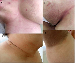 Resolution of the lesions after 2 months of treatment.