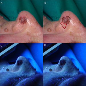 (A and B) Clinical images of LMM on the left nostril. Brownish macule measuring 10mm×10mm with a thick pigmented pseudoreticulum. In red, the clinically nonvisible pigmented area. (C and D) After illumination using Wood