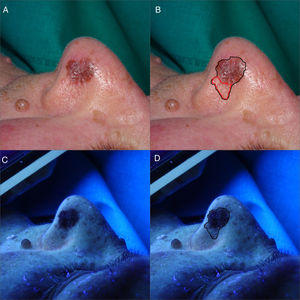 (A and B) Clinical images of LMM on the left nostril. Brownish macule measuring 10mm×10mm with a thick pigmented pseudoreticulum. In red, the clinically nonvisible pigmented area. (C and D) After illumination using Wood's light, the clinically nonvisible pigmented area can be seen. In black, the definitive surgical margin of 25mm×18mm.