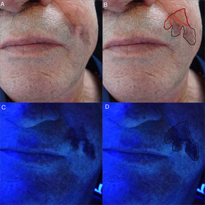 (A and B) Clinical images of LM in the left nasolabial fold. Poorly delineated hyperpigmented macule measuring approximately 2cm. In red, the clinically nonvisible pigmented area. (C and D) After illumination using Wood's light, the clinically nonvisible pigmented area can be seen. In black, the definitive surgical margin of 45mm×30mm.