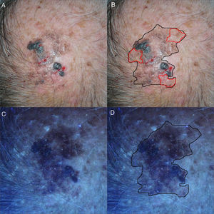 (A and B) Clinical images of LMM on the cranial apex. Heterogeneous, poorly delineated hyperpigmented mark on the cranial apex measuring approximately 3cm. In red, the clinically nonvisible pigmented area. (C and D) After illumination using Wood