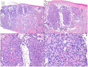 Basosquamous carcinoma (hematoxylin and eosin). A, At low magnification, areas of infiltrative BCC with basaloid nests can be seen in the deep part of the lesion, whereas areas with squamous differentiation are observed in the superficial part (×40). B, In these nests, we do not observe the typical row of columnar cells at the periphery of the islets as is the case in conventional BCC (×100). C, Tumor cells show eosinophilic staining and a spindle-cell morphology, more reminiscent of squamous cell carcinoma (×200). D, Detail of the squamous-like cells (×400).