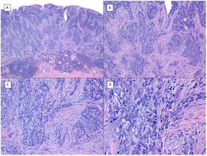 Metatypical pattern of BCC with partial response after treatment with sonidegib (hematoxylin and eosin). A, In the low-magnification image of the punch biopsy, BCC can be seen in the upper part of the image, with marked inflammatory reaction at the deep dermal margin of the tumor (×40). B, Nests of undifferentiated BCC with desmoplastic stromal reaction with abundant mucin (×100). C, These nests of metatypical BCC lack peripheral palisading and there are no retraction clefts between the epithelium and the stroma (×200). D, The high-magnification image shows the typical appearance of metatypical cells, which are less basophilic and larger than cells in conventional BCC and less eosinophilic and smaller than those of squamous cell carcinoma (×400).