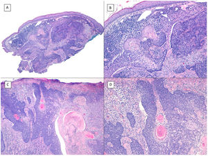 BCCs with squamous cell differentiation (A, B) and keratinization (C, D) (hematoxylin and eosin). A, In BCC with squamous cell differentiation, a predominance of conventional nodular BCC can be observed at low magnification (×40). B, Focally, 2 well differentiated squamous areas can be seen in one of the typically basaloid tumor nests (×100). C, In keratinizing BCC, conventional nests of nodular BCC predominate with areas of necrosis on the right side (×100). D, At higher magnification, 2 foci of abrupt keratinization can be seen in one of the islets (×200).