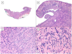 Infiltrative/morpheaform pattern (hematoxylin and eosin). A, In the debulking visualization prior to Mohs surgery, a tumor is seen invading deep layers, with massive involvement of the hypodermis (×10). B, In the most superficial part of the tumor, there are areas of conventional nodular BCC (×40). C, In deep areas of the same tumor, the invasive and morpheaform pattern predominates. These areas show how tumor cells are arranged in rows of narrow and elongated nests embedded in a densely collagenous stroma (×200). D, Detail of the morpheaform pattern in which dense collagen can be seen in thick, almost keloid bands (×400).