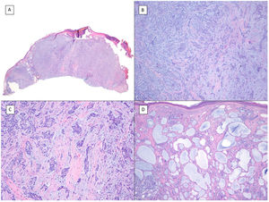 Mixed pattern (hematoxylin and eosin). A, BCC with a predominantly invasive and morpheaform pattern and adenoid areas in the left half of the tumor (×10). B, Infiltrative/morpheaform pattern with small and elongated epithelial islets (×100). C, Detail of the morpheaform pattern with invasive epithelial nests and desmoplastic stromal reaction (×200). D, Detail of the adenoid part of the same tumor, with cystic spaces filled with mucin (×200).