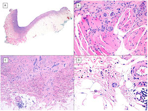 Micronodular pattern (hematoxylin and eosin). A, BCC located in the nasogenian fold and cheek with a micronodular pattern that predominantly affects the dermis with points of extension to the hypodermis and striated muscle (×10). B, Detail of the small and rounded nests typical of this variant of BCC invading the striated muscle (×200). C, Image of extension toward the hypodermis of the same tumor (×100). D, Detail of (C) in which a small nest can be seen distant from the primary tumor, demonstrating the incohesive nature of the periphery of micronodular BCC (×400).
