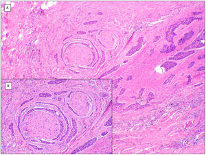 Perineural invasion (hematoxylin and eosin). A, Perineural space surrounding each of the nerve filaments appears invaded by rows of morpheaform BCC cells (×100). B, Detail of perineural invasion by BCC nests (×200).