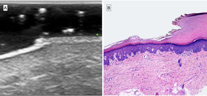 Correlación entre los hallazgos ecográficos e histológicos. A)Imagen ecográfica modoB, 22mHz. Estrechamiento epidérmico brusco y de forma inclinada, perdiendo la estructura en bicapa hiperecogénica de la piel acral y asemejando los peldaños de una escalera. Disminución de la ecogenicidad del SLEB bajo la epidermis afecta. B)Histopatológicamente se observa una depresión brusca de la epidermis por disminución de la capa córnea y presencia de corneocitos desflecados. Se puede apreciar la alta correlación ecográfico-histológica.