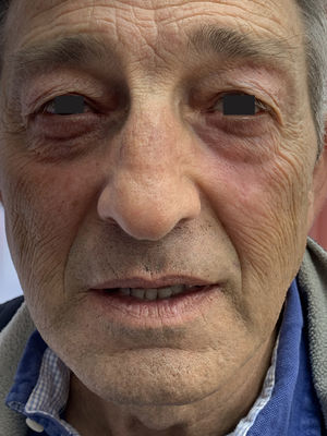 Resolución de la dermatosis y el ectropión tras tratamiento con dipropionato de betametasona+calcipotriol.