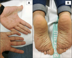 Clavos sifilíticos. Pápulas planas hiperqueratósicas eritemato-amarillentas que afectan a las palmas de ambas manos (A) y a las plantas de ambos pies (B).