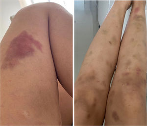 Contusiones, equimosis espontáneas e hiperpigmentación postinflamatoria predominantemente en las superficies extensoras de los miembros inferiores.