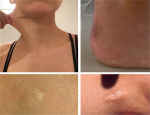 Hiperelasticidad de la piel, estiramiento por encima de 3 cm del cuello (arriba izquierda), pápulas piezogénicas (arriba derecha), cicatrices atróficas (abajo).