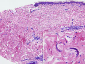 Se muestra un moderado infiltrado inflamatorio perivascular en dermis con presencia de linfocitos y eosinófilos. En la dermis profunda, entre los haces de colágeno, hay algunas estructuras alargadas con punteado basófilo en su interior que se corresponden con larvas de un nematodo (recuadro).