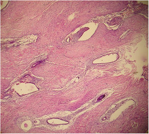 Umbilical endometriosis. Note the foci of endometrioid glands and stroma in the subcutaneous tissue in a 32-year-old female. (hematoxylin–eosin, original magnification ×100).