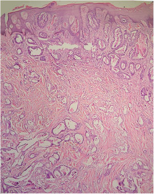 Umbilical metastasis of serous papillary cystadenocarcinoma arising from the ovary in a 40-year-old female. (hematoxylin–eosin, original magnification ×60).