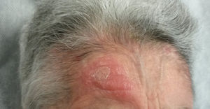Placa de 3,5 cm, eritematoedematosa e infiltrada localizada en la frente, que correspondía a una lesión por Leishmania.