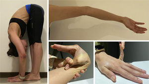 Assessment of joint hypermobility with the Beighton score: Ability to flex spine placing palms to floor without bending knees (Left) – 1 point; Active hyperextension of elbow >10° (Superior right) – 1 point each side; Active hyperextension of knee >10° – was not present; Passive apposition of thumb to forearm (Bottom middle) – 1 point each side; Passive hyperextension of fifth metacarpal-phalangeal joint >90° (Bottom right) – 1 point each side.