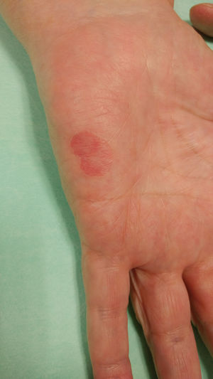 Photograph of the patient's left palm, showing an erythematous, pinkish, slightly depressed plaque on the hypothenar eminence. The lesion has well-circumscribed borders and measures 14mm along the longest axis.