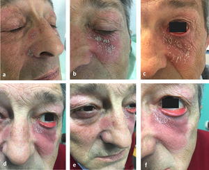 Three salmon-colored, discoid facial lesions with thick scaling. The largest one involved the lower eyelid and progressed to cause ectropion. A and B, Presentation at the first clinical visit. C, Presentation 2 months later. D–F, Presentation 7 months later.