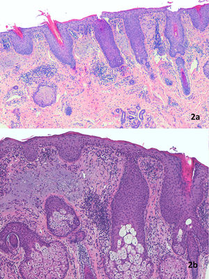 A) Epidermal hyperplasia with marked keratotic spikes in the follicular ostium and parakeratosis that is accentuated in the region surrounding the follicular infundibulum. The lymphocytic infiltrate is perivascular in the dermis. Hematoxylin–eosin (H&E) staining, magnification ×40. B) Evident epidermal acanthosis with hyperkeratosis, corneal plugs, and parakeratosis often located around follicles. Munro abscesses were not observed. Thickening of the granular layer and mild spongiosis with lymphocytic exocytosis. Perivascular lymphocytic infiltrate in the dermis. There is basophilic degeneration of collagen, without increased mucin deposition. H&E staining, magnification ×100.