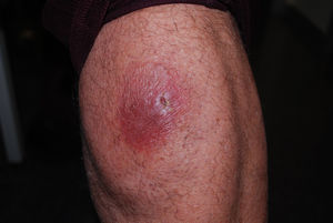 Clinical image showing an atrophic-looking, erythematous, violaceous plaque on the thigh.