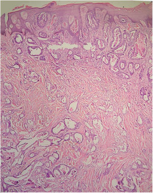 Metástasis umbilical de cistoadenocarcinoma papilar seroso originado en el ovario de una mujer de 40 años (hematoxilina-eosina, ampliación original ×60).