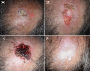 Panel A) Presentación clínica inicial del tumor 6 (Paciente 3) localizado en la zona media del cuero cabelludo. Se observa una respuesta inflamatoria intensa tras la primera sesión de criocirugía del «ciclo de tratamiento 7/2». Panel B) Restos del tumor tras terminar el primer ciclo de tratamiento. Sólo se observó una respuesta parcial. Panel C) Zona donde se encontraba el tumor al final del segundo ciclo de tratamiento. Panel D) Imagen tras 12 meses de seguimiento. El proceso de curación es excelente en un área que normalmente requiere procedimientos complejos de reconstrucción quirúrgica.