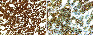 (A) Intense and diffuse positive staining of the neoplastic cells for CK7 (×100). (B) The ductal structures are marked with EMA (×100).