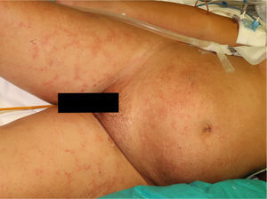 Petechiae grouped in a reticular pattern in the periumbilical region and on both thighs.