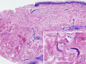 Moderate perivascular inflammatory infiltrate in the dermis with lymphocytes and eosinophils. Elongated structures with interior basophilic stippling in the deep dermis, which correspond to nematode larvae (box).