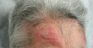 Erythematous–edematous infiltrated plaque measuring 3.5cm, located on the forehead, corresponding to a lesion due to Leishmania.