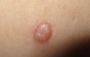 Imagen clínica. Tumor blanquecino, con zona periférica parduzca, con varias telangiectasias en superficie y bien delimitado.