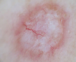 Imagen dermatoscópica. Fondo blanquecino homogéneo con vasos arboriformes periféricos y halo eritematoparduzco.