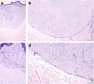 Imágenes histopatológicas. a) Lesión nodular dérmica, circunscrita y no encapsulada (hematoxilina-eosina, × 20). b) Haces de colágeno hialinizado, paucicelular, separados por hendiduras y adoptando un patrón estoriforme. (hematoxilina-eosina, × 40). c y d) A mayor detalle, «collarete» de estructuras vasculares de pequeño tamaño colapsadas, con formación de microtrombos y extravasación eritrocitaria (hematoxilina-eosina, × 200).