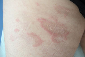 Imagen clínica. En cara posterior de muslo izquierdo, placas anulares de bordes eritematosos con collarete descamativo en margen interno.
