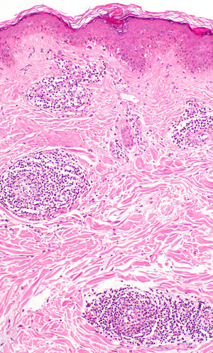 Imagen histopatológica. En dermis superficial, discreto infiltrado inflamatorio de predominio linfocitario perivascular (hematoxilina-eosina, × 100).
