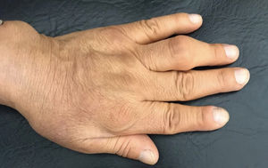 Placa indurada ligeramente eritematoedematosa, de límites difusos, sobre tabaquera anatómica y región metacarpiana de 2.° y 3.er dedo de dorso de mano izquierda.