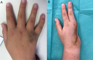 Mano derecha de la paciente. A) Aspecto preoperatorio con placa marronácea, ligeramente sobreelevada a nivel de la 4.ª comisura. B) Aspecto postoperatorio.