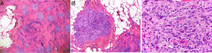 Imagen histológica de tumor fibrohistiocitario plexiforme. A) Hematoxilina-eosina ×4. B) Hematoxilina-eosina ×10. C) Hematoxilina-eosina ×200.