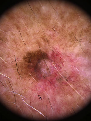 Dermatoscopía de la lesión.