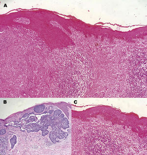 Estudio histopatológico. a) Se observa colisión de tumores. b) Carcinoma basocelular. c) Melanoma lentigo maligno.