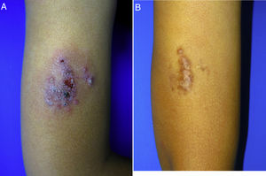 Leishmaniasis cutánea infantil. A) Placa eritematoviolácea exudativo-costrosa muy dolorosa de 8 x 6 cm en el brazo de un niño de 10 años. B) Control seis meses después del tratamiento con miltefosina oral. Placa marronácea de aspecto residual en el brazo. El paciente se mantenía asintomático.