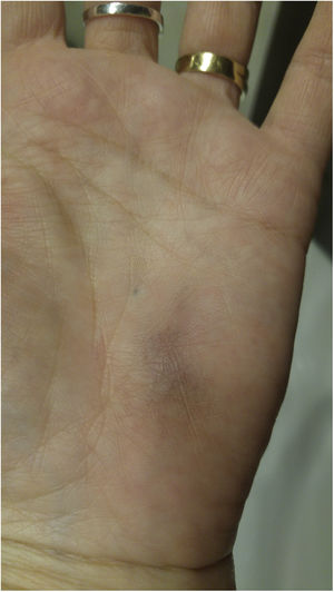 Púrpura equimótica en palma de la mano.