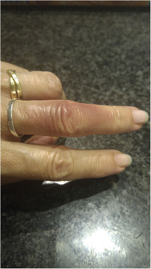 Hematoma en dorso del dedo de la mano.