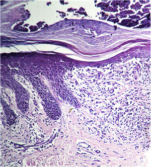 Light microscopy image shows parakeratosis and supra-papillary thinning. Rete ridges are elongated and acanthotic, enclosing lymphohistiocytic infiltrate and dilated capillaries. (hematoxylin–eosin, original magnification ×10).