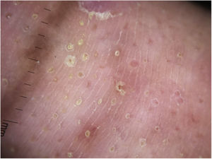 Imagen dermatoscópica donde se observan depresiones y fosas ovales rellenas de tapones amarillentos, escamas periféricas y vasos lineales sobre un fondo eritematoso.