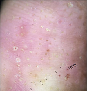 Imagen dermatoscópica donde se observan lesiones digitales con hemorragias punteadas y fosas.