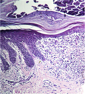 Imagen de microscopia óptica donde se observan paraqueratosis y reducción supra-papilar. Puentes interpapilares elongados y acantósicos, delimitando infiltrado linfohistioquístico y capilares dilatados (hematoxilina & eosina, ampliación original ×10).